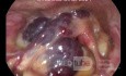 Hemangioma laríngeo en un paciente adulto