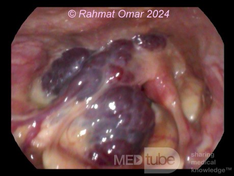 Hemangioma laríngeo en un paciente adulto