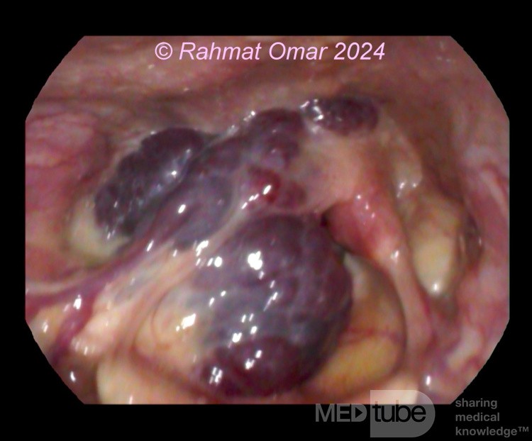 Hemangioma laríngeo en un paciente adulto