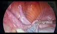 Apertura laparoscópica de una obstrucción de trompa de Falopio izquierda