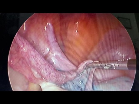 Apertura laparoscópica de una obstrucción de trompa de Falopio izquierda