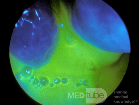 La prueba de fluoresceína para la rinorrea del LCR