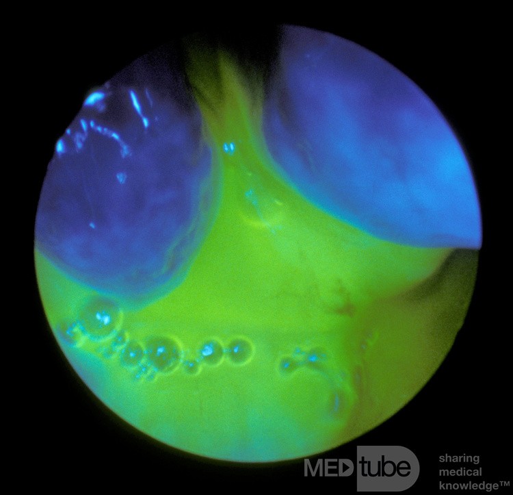 La prueba de fluoresceína para la rinorrea del LCR