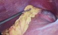 Quiste hidatidico y colecistitis cronica calculosa resolucion por laparoscopia