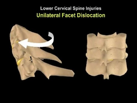 Fractura de columna cervical