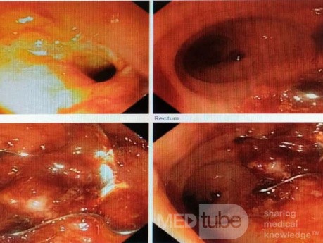 Cierre de fístula rectovaginal debido a isquemia por radiación para cáncer de recto después de la cirugía