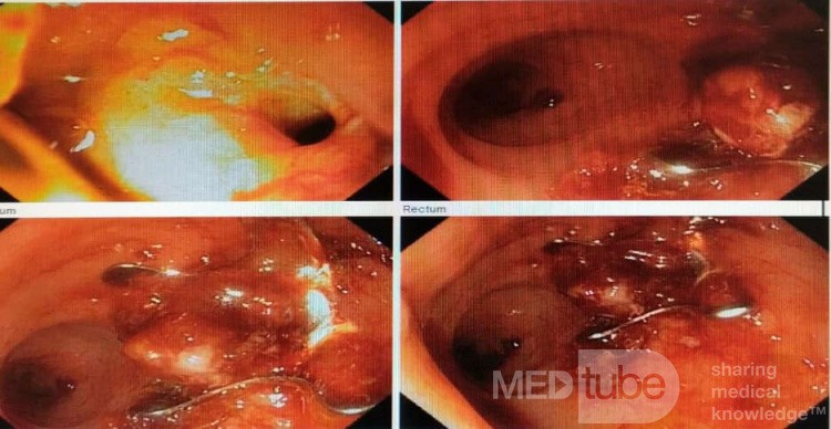 Cierre de fístula rectovaginal debido a isquemia por radiación para cáncer de recto después de la cirugía