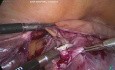 Torsión de ovario sólido post histerectomía 