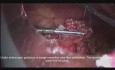Cirugía cooperativa laparoscópica y endoscópica para la resección en cuña de un tumor carcinoide gástrico