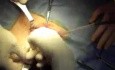 Reparación protésica de hernia inguinal