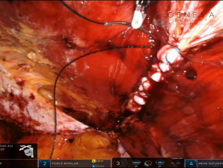 TARUP robótico de abajo hacia arriba para diástasis de rectos grandes de 10 cm y plicatura invertida.