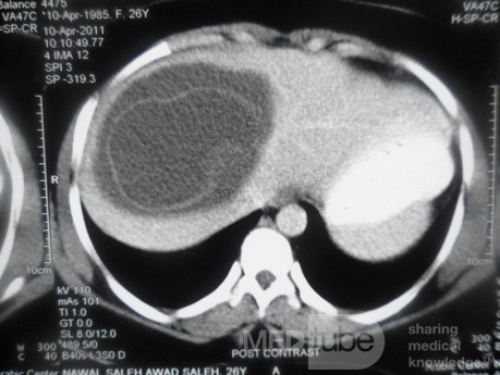 ِ TC abdominal - quiste hidatídico hepático