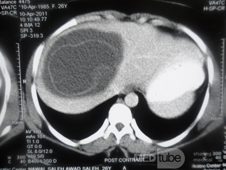 ِ TC abdominal - quiste hidatídico hepático