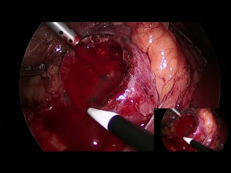 Nefrectomia parcial derecha laparoscopica sin isquemia
