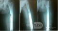 Osteoma osteoide con fractura inminente de fémur