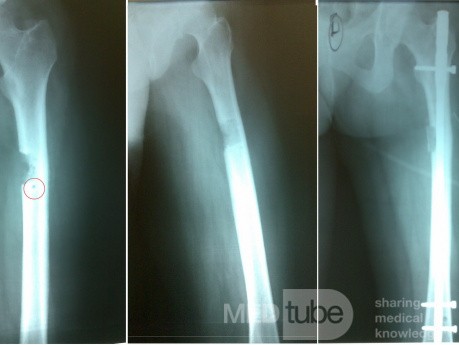 Osteoma osteoide con fractura inminente de fémur