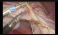 Histerectomía total laparoscópica con uso de tijeras bipolares