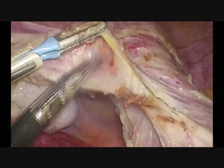 Histerectomía total laparoscópica con uso de tijeras bipolares