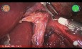 Toupet Fundoplication with Versius – L. Boni