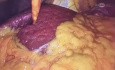 Hernia hiatal tipo 3 en paciente muejer