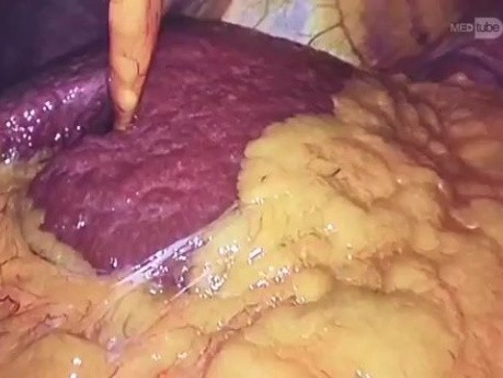 Hernia hiatal tipo 3 en paciente muejer