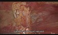 Cirugía de una hernia umbilical usando el método e-TEP con una malla