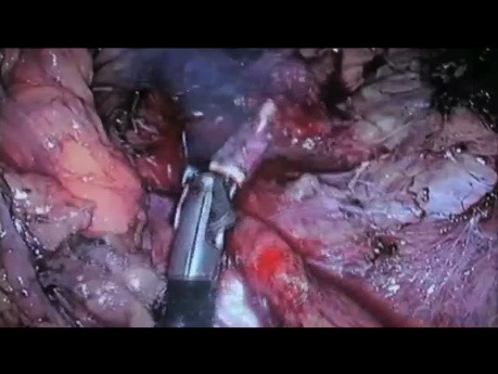 Adrenalectomía para adenoma izquierdo LESS 