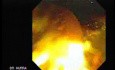 Adenocarcinoma de la ampolla de Vater (1 de 5)