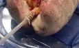 Técnica perfusión pulmonar ex vivo modificada para pulmón dañado