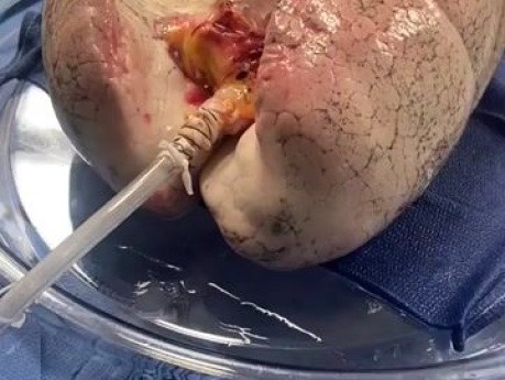 Técnica perfusión pulmonar ex vivo modificada para pulmón dañado