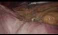 Técnica paso a paso de hemicolectomía derecha laparoscópica con anastomosis intracorpórea