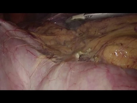 Técnica paso a paso de hemicolectomía derecha laparoscópica con anastomosis intracorpórea