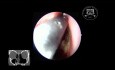 Operación de reparación de la resección del papiloma nasal