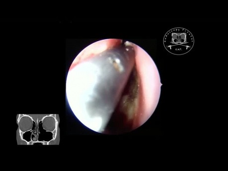 Operación de reparación de la resección del papiloma nasal