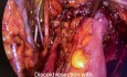 Résection Discoïde avec Hystérectomie dans l'Endométriose Profonde