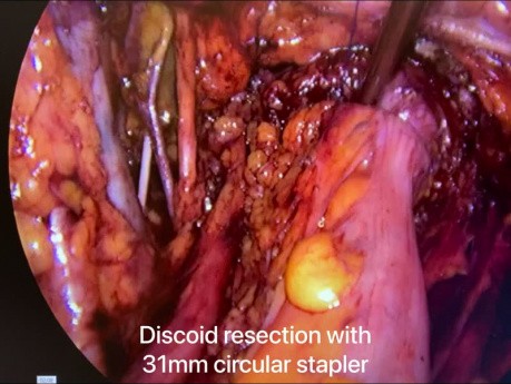 Résection Discoïde avec Hystérectomie dans l'Endométriose Profonde