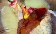 Extracción de pulmón en pacientes con drenaje venoso pulmonar anormal