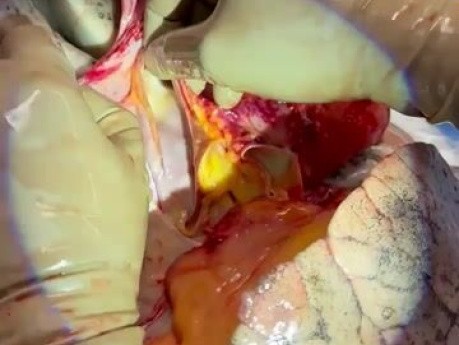Extracción de pulmón en pacientes con drenaje venoso pulmonar anormal