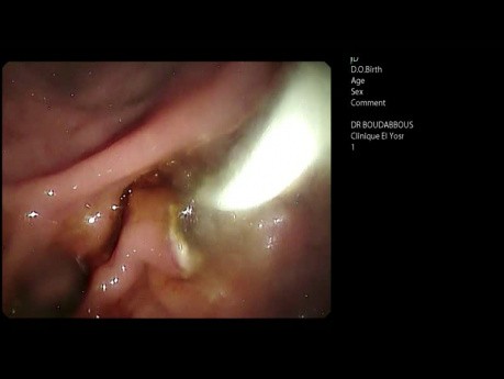 CPRE y SEMS para el cáncer de páncreas avanzado