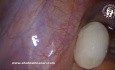 Cuerpo suelto peritoneal