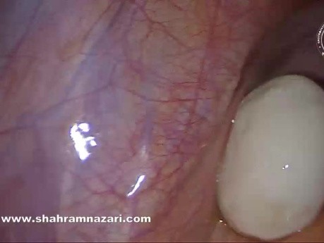 Cuerpo suelto peritoneal