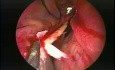 Septoplastia nasal - endoscopia