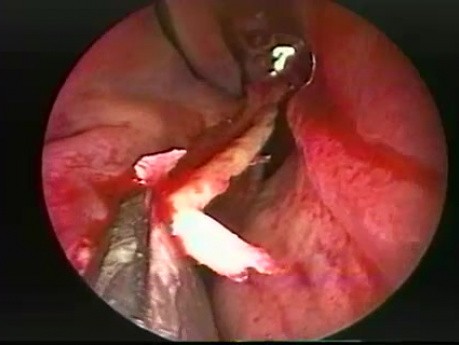 Septoplastia nasal - endoscopia