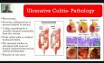 Enfermedades Inflamatorias Intestinales - hemorragia digestiva baja