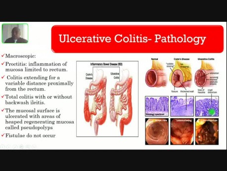 Enfermedades Inflamatorias Intestinales - hemorragia digestiva baja