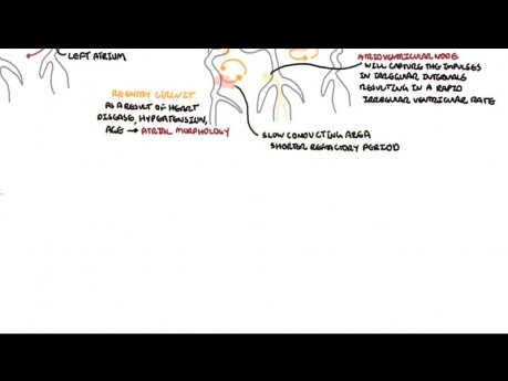 Descripción general de la fibrilación auricular - ECG, tipos, fisiopatología, tratamiento, complicaciones