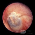 Fractura del hueso temporal [oído izquierdo]