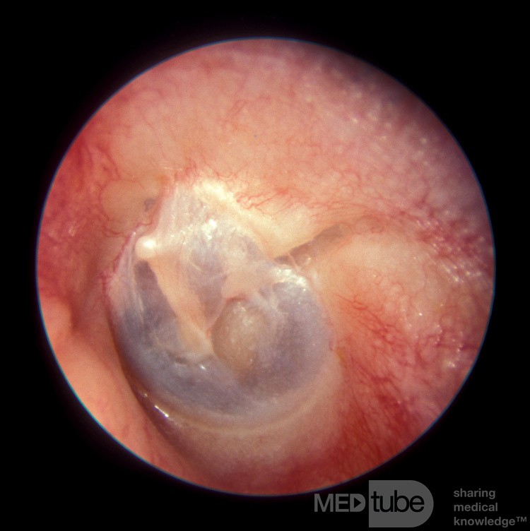 Fractura del hueso temporal [oído izquierdo]