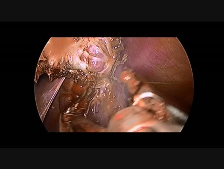 Resección laparoscópica de quiste esplénico