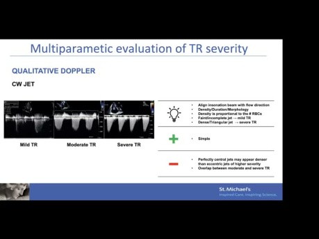 Evaluación ecográfica de la insuficiencia tricuspídea: mecanismo, cuantificación y selección del dispositivo